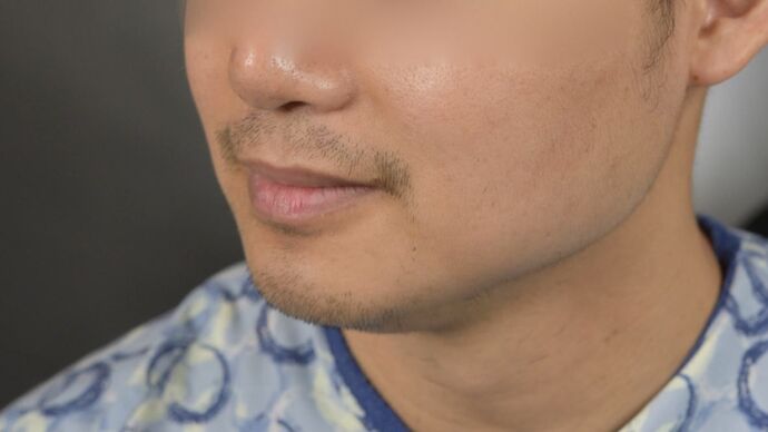 Facial Hair Transplantation: Case 10 - Before