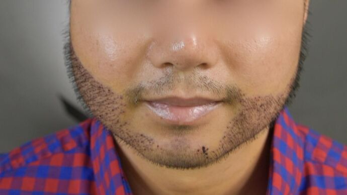 Facial Hair Transplantation: Case 10 - After