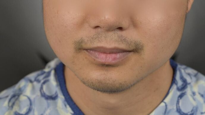 Facial Hair Transplantation: Case 10 - Before