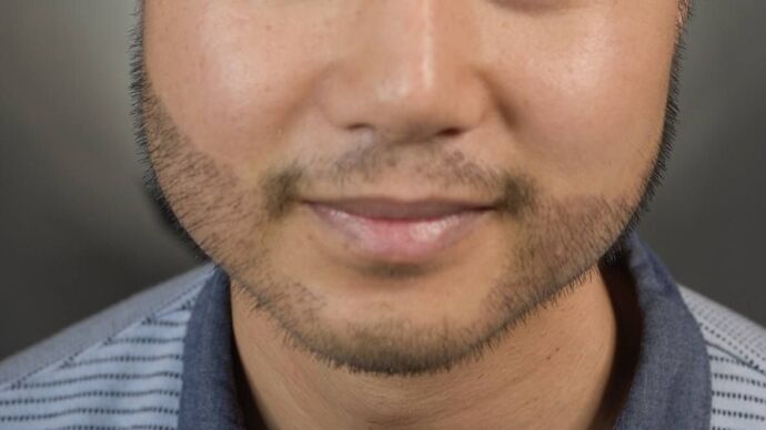 Facial Hair Transplantation: Case 10 - After