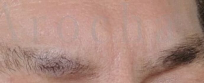 Facial Hair Transplantation Case 11 - Before