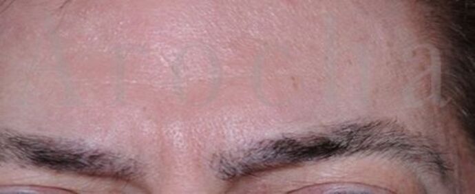 Facial Hair Transplantation Case 11 - After