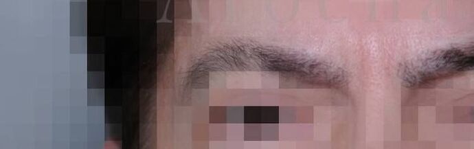 Facial Hair Transplantation: Case 11 - After