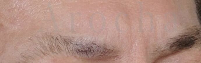 Facial Hair Transplantation: Case 11 - Before