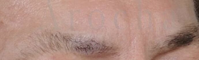 Facial Hair Transplantation: Case 11 - Before