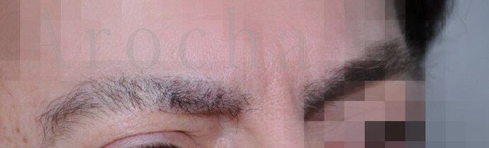 Facial Hair Transplantation: Case 11 - After