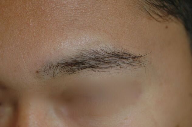 Facial Hair Transplantation Case 12 - After