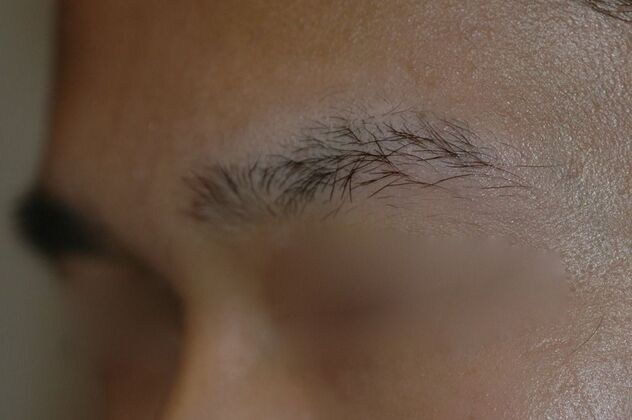 Facial Hair Transplantation Case 12 - Before