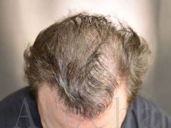 Scalp Micropigmentation Case 1 - Before