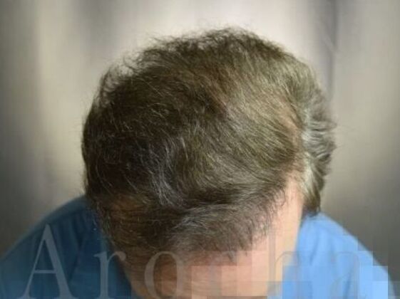 Scalp Micropigmentation Cases