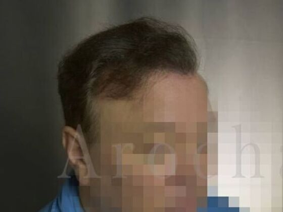 Scalp Micropigmentation: Case 1 - After