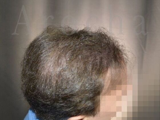 Scalp Micropigmentation: Case 1 - After