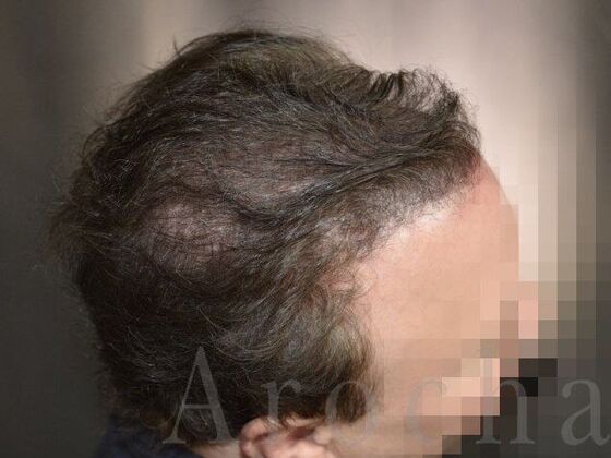 Scalp Micropigmentation: Case 1 - Before