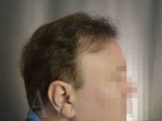 Scalp Micropigmentation: Case 1 - After