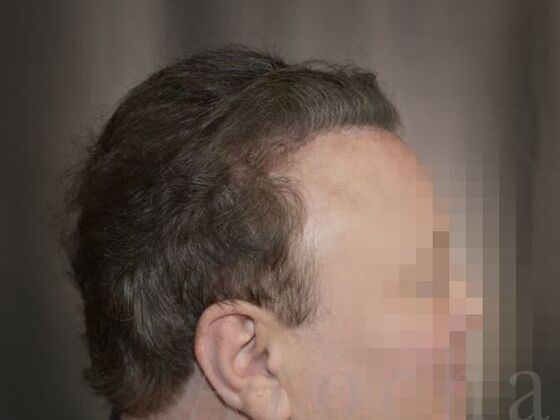 Scalp Micropigmentation: Case 1 - Before