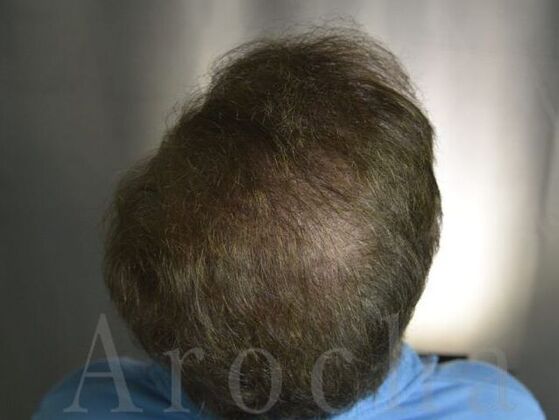 Scalp Micropigmentation: Case 1 - After