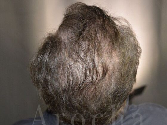 Scalp Micropigmentation: Case 1 - Before