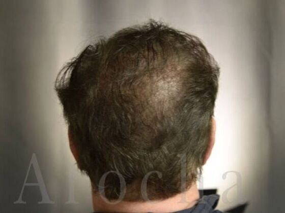 Scalp Micropigmentation: Case 1 - Before
