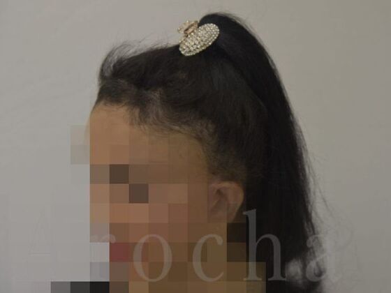 Scalp Micropigmentation Case 2 - After