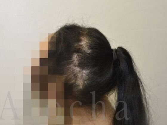 Scalp Micropigmentation Case 2 - Before