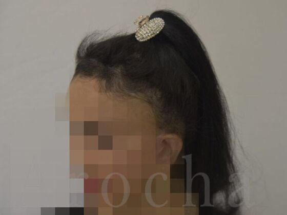 Scalp Micropigmentation: Case 2 - After