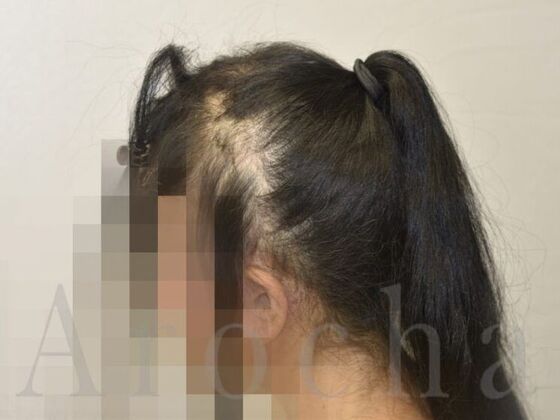 Scalp Micropigmentation: Case 2 - Before