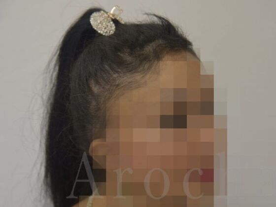 Scalp Micropigmentation: Case 2 - After