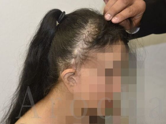 Scalp Micropigmentation: Case 2 - Before