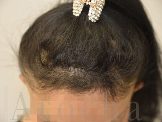 Scalp Micropigmentation: Case 2 - After