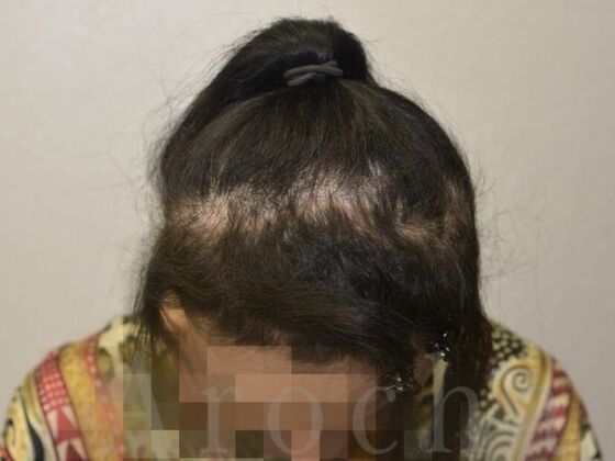 Scalp Micropigmentation: Case 2 - Before