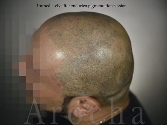 Scalp Micropigmentation Case 3 - After