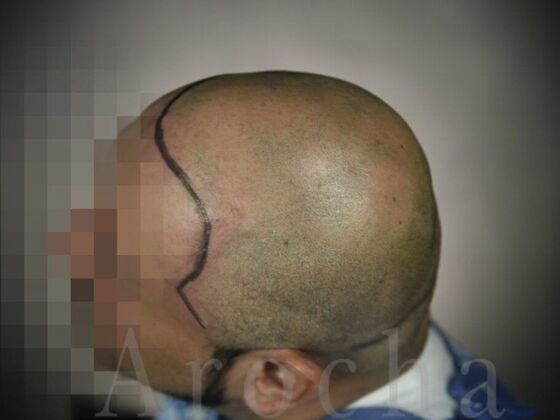 Scalp Micropigmentation Case 3 - Before