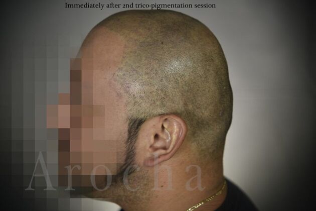 Scalp Micropigmentation: Case 3 - After