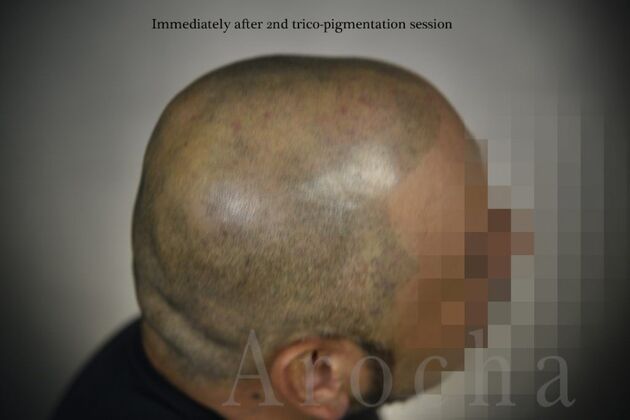 Scalp Micropigmentation: Case 3 - After