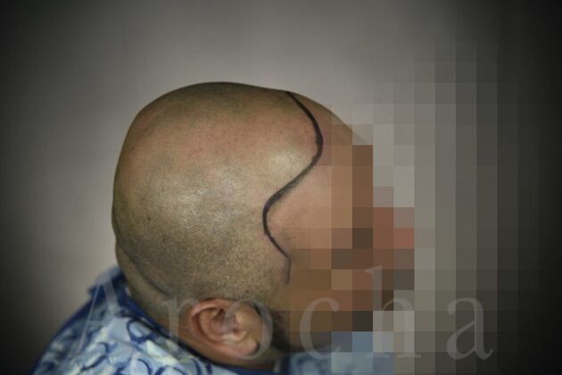 Scalp Micropigmentation: Case 3 - Before