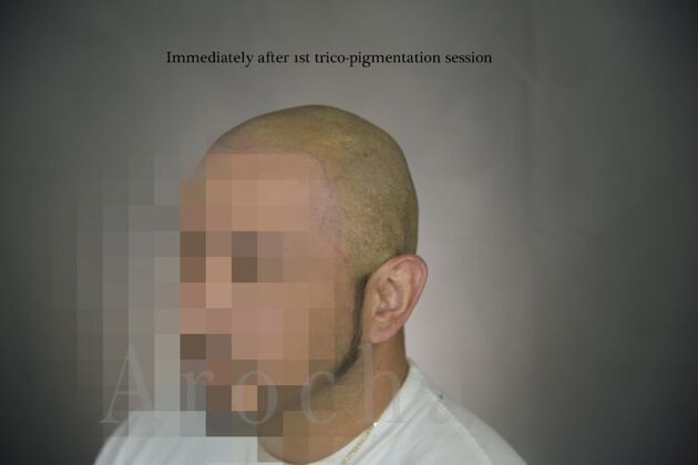 Scalp Micropigmentation: Case 3 - After