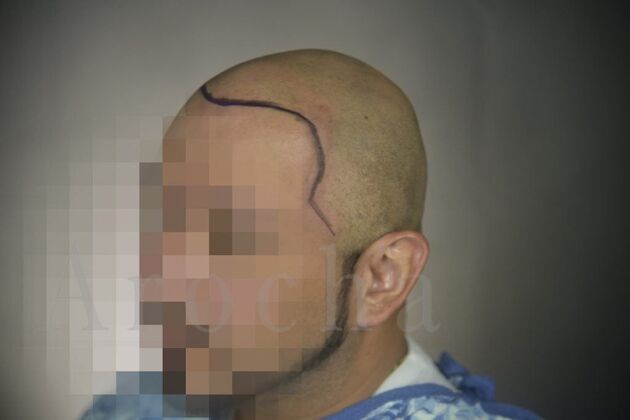 Scalp Micropigmentation: Case 3 - Before