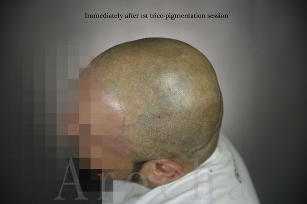 Scalp Micropigmentation: Case 3 - After