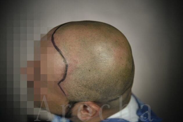 Scalp Micropigmentation: Case 3 - Before