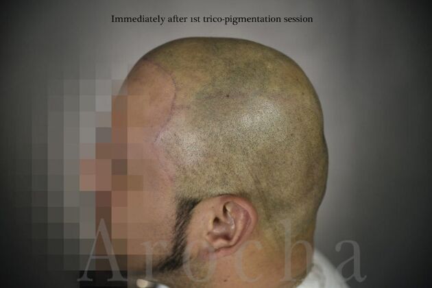 Scalp Micropigmentation: Case 3 - After