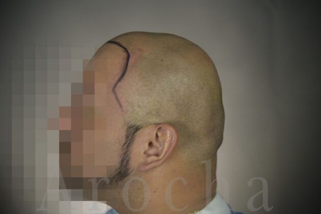 Scalp Micropigmentation: Case 3 - Before