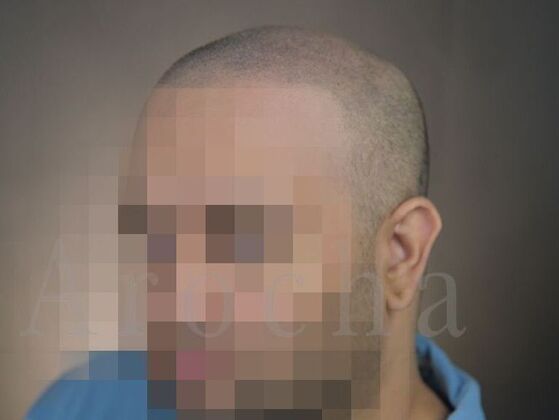 Scalp Micropigmentation Case 4 - After