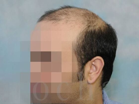 Scalp Micropigmentation Case 4 - Before