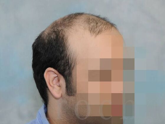 Scalp Micropigmentation: Case 4 - Before