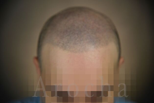 Scalp Micropigmentation: Case 4 - After