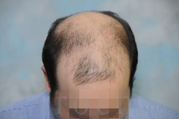 Scalp Micropigmentation: Case 4 - Before