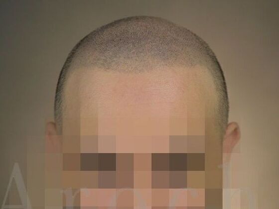 Scalp Micropigmentation: Case 4 - After