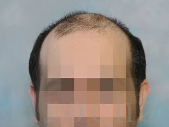 Scalp Micropigmentation: Case 4 - Before