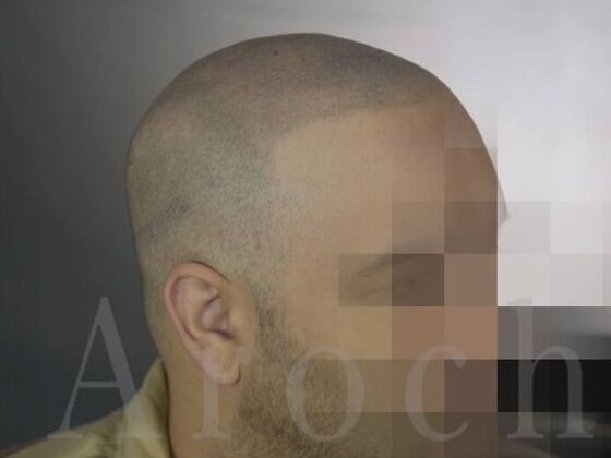 Scalp Micropigmentation: Case 4 - After