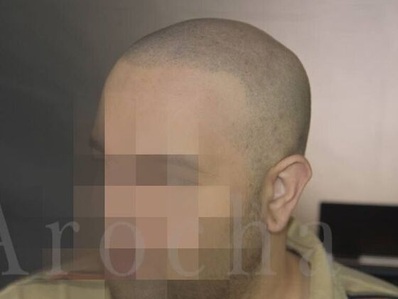 Scalp Micropigmentation: Case 4 - After